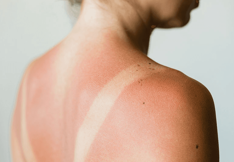 woman with a severe sunburn on her face and shoulders