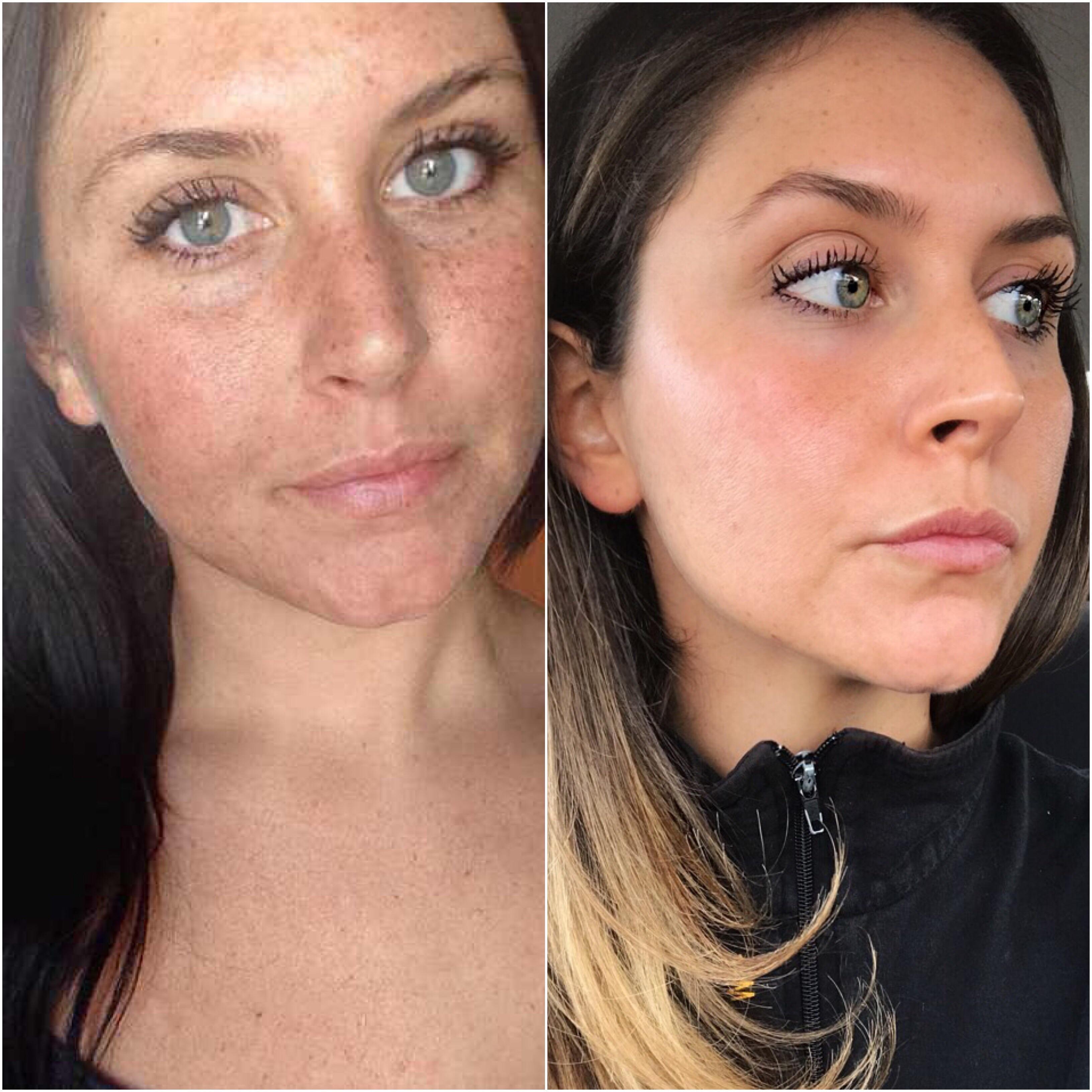 Comparison of sun damaged skin vs healthy skin