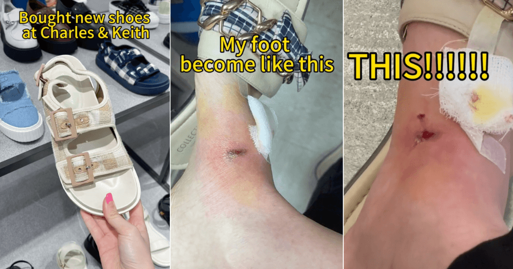 woman with blistered feet after wearing sandals