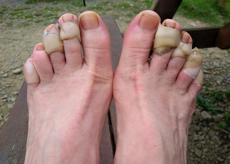 woman with sore feet after walking a lot while traveling